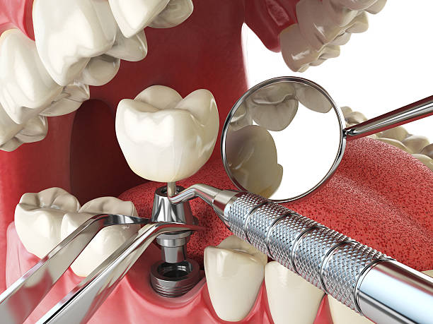 Best Knocked-Out Tooth Emergency  in Augusta, KS